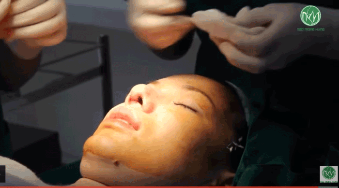 Nâng mũi bao lâu thì hết sưng