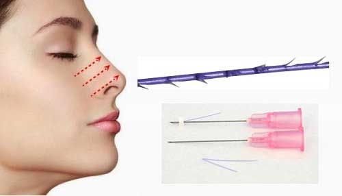 Nâng mũi bằng chỉ Hàn Quốc