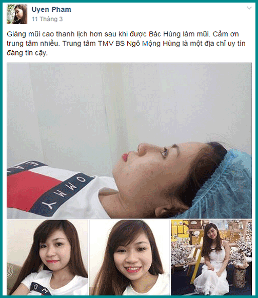 Mũi tẹt và mũi cao