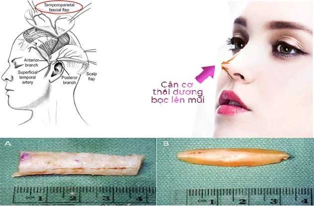 Nâng mũi bọc cân giá bao nhiêu