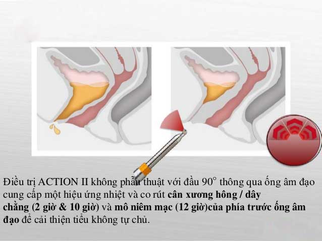 Thẩm mỹ vùng kín giá bao nhiêu