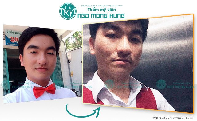Thu gọn cánh mũi giá bao nhiêu