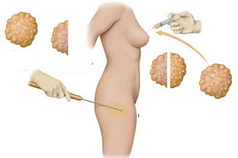 Công nghệ nâng ngực hút mỡ an toàn Công nghệ nâng ngực hút mỡ an toàn