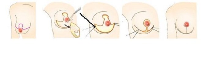 Cách làm ngực bớt chảy xệ
