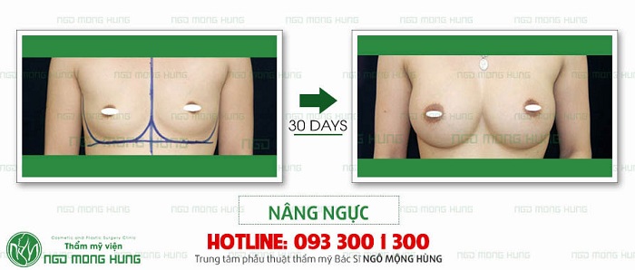 Áo nâng ngực đẹp