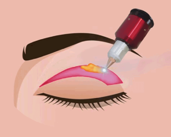 Cắt bọng mỡ mắt bằng laser