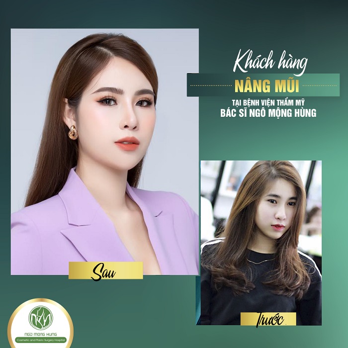 Bán kẹp nâng mũi Hà Nội