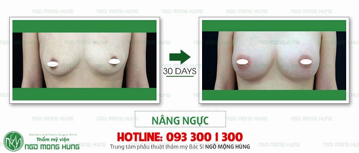 Các phương pháp nâng ngực an toàn Các phương pháp nâng ngực an toàn