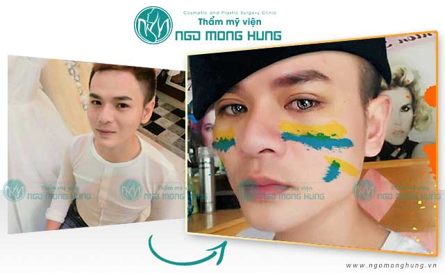 Nâng mí mắt bao nhiêu tiền