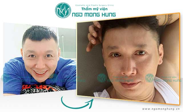 Cắt mí mắt cho nam giới