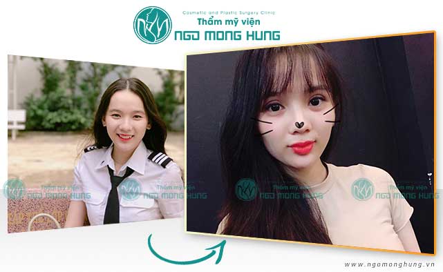 Cắt mí mắt cho nam giới