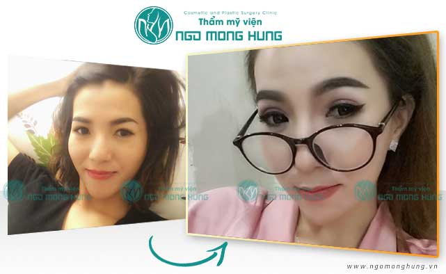 Cắt mí mắt cho nam giới