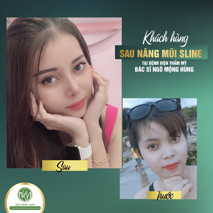 Chi phí nâng mũi bằng Aquamid Chi phí nâng mũi bằng Aquamid
