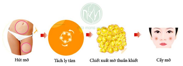 Hốc mắt bị sâu