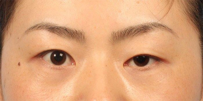 Mắt cận bị sụp mí