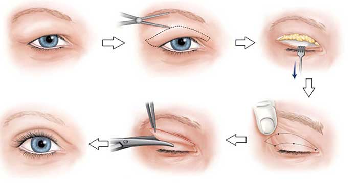 Đuôi mắt bị sụp mí