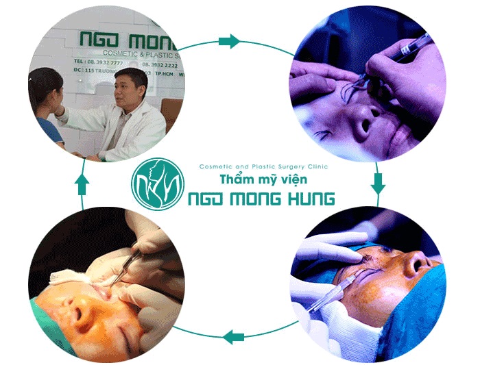 Chi phí phẫu thuật sụp mí mắt bẩm sinh