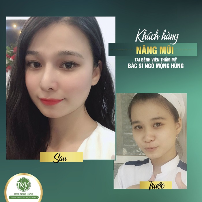 Sửa mũi Hàn Quốc bằng sụn nhân tạo
