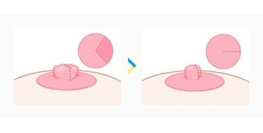 Thu nhỏ núm vú webtretho