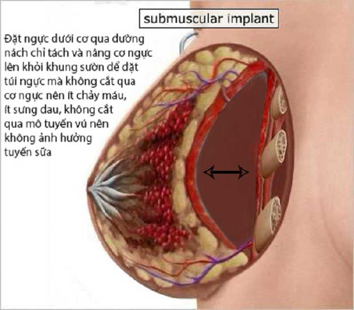 Nâng ngực trên cơ và dưới cơ Nâng ngực trên cơ và dưới cơ