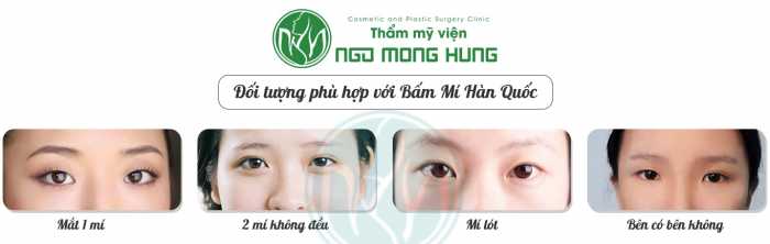 Bấm mí Hàn Quốc có đẹp không