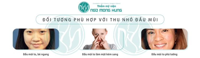 Chi phí thu nhỏ cánh mũi và đầu mũi