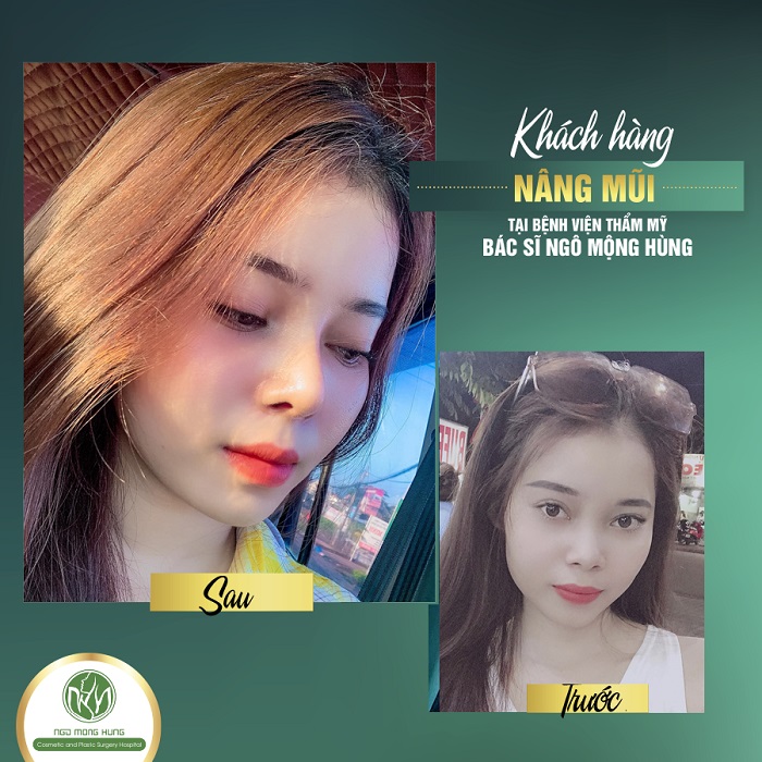 Lỗ mũi lớn và hếch lên