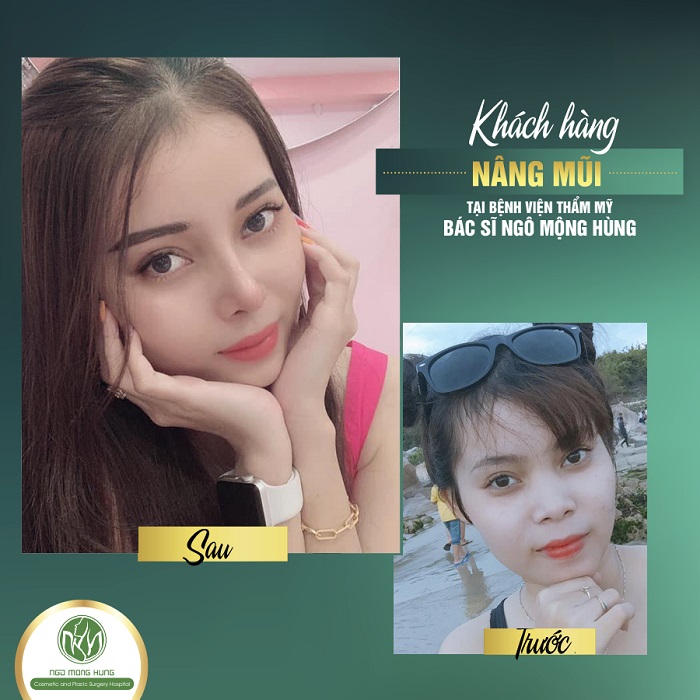Mũi tẹt và mũi cao