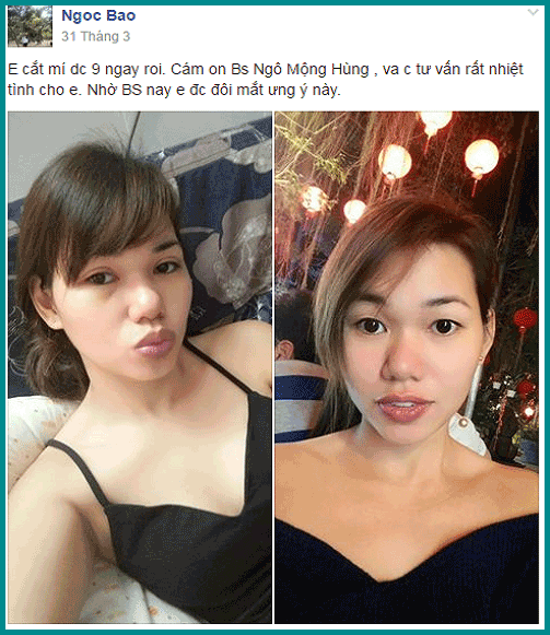 Mắt bị xếch