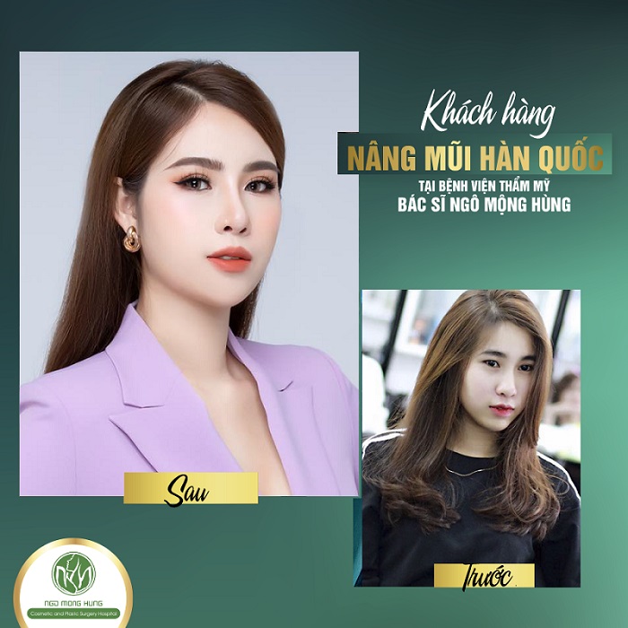 Giá phẫu thuật thẩm mỹ mũi Hàn Quốc