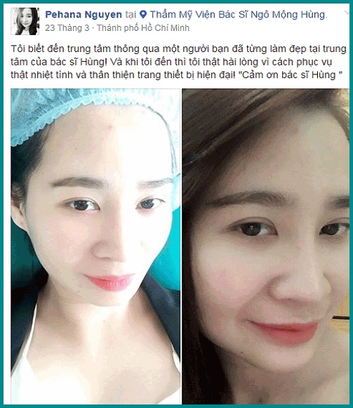 Giá thu nhỏ núm vú