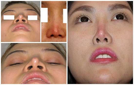 Nâng mũi và hậu quả Nâng mũi và hậu quả