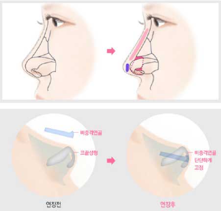 Giá của phẫu thuật nâng mũi