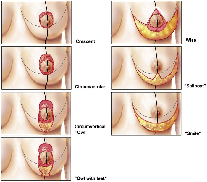 Sinh con xong ngực bị chảy xệ