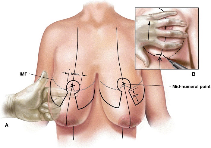 Ngăn ngừa ngực chảy xệ