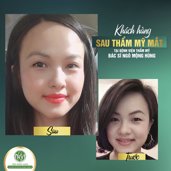 Hút mỡ mắt ở đâu