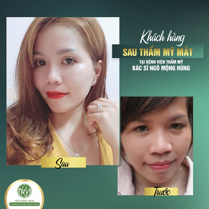 Hút mỡ mắt ở đâu