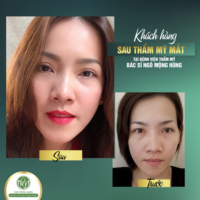 Hút mỡ mắt ở đâu