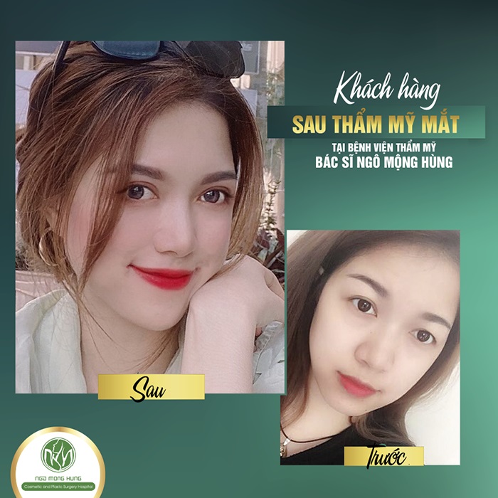 Hút mỡ mắt ở đâu