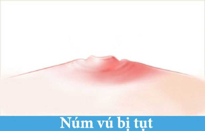Điều trị tụt núm vú