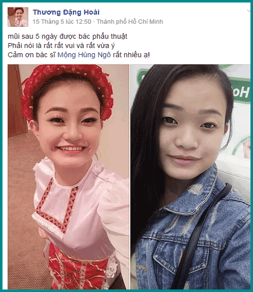 Mũi hơi tẹt