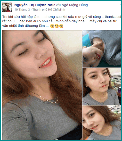 Thu gọn cánh mũi có đau không