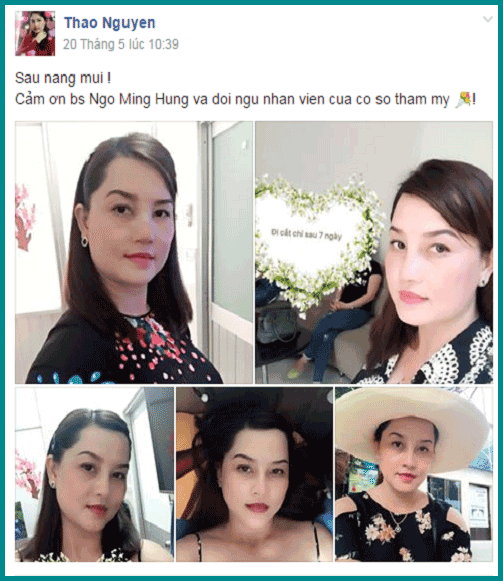 Nâng mũi S line giảm giá