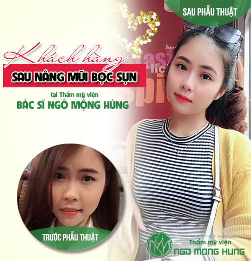 Làm gì sau khi phẫu thuật nâng mũi