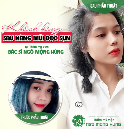 Làm gì sau khi phẫu thuật nâng mũi