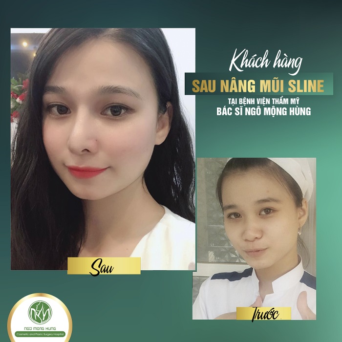 Làm gì sau khi phẫu thuật nâng mũi