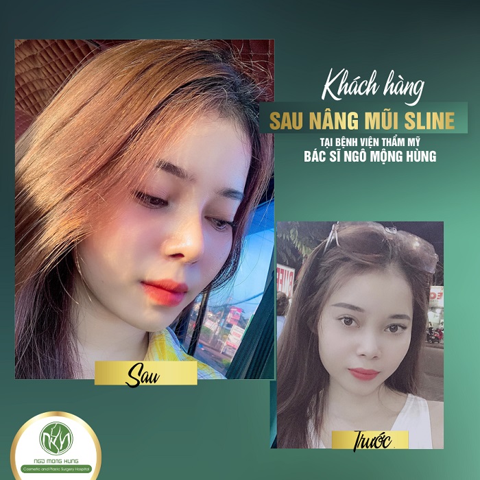 Làm gì sau khi phẫu thuật nâng mũi