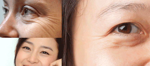 Lấy mỡ mí mắt bằng Laser