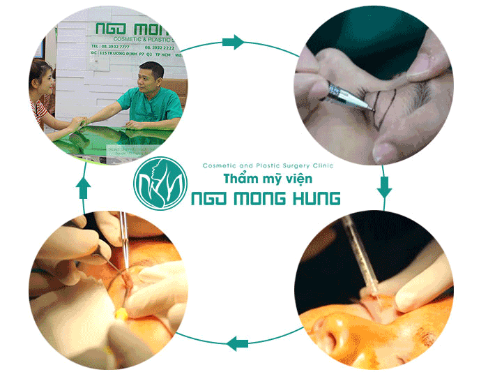 Đông y chữa bệnh sụp mí mắt