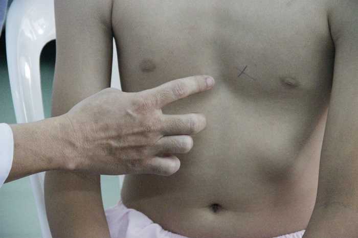 Chi phí phẫu thuật lõm ngực